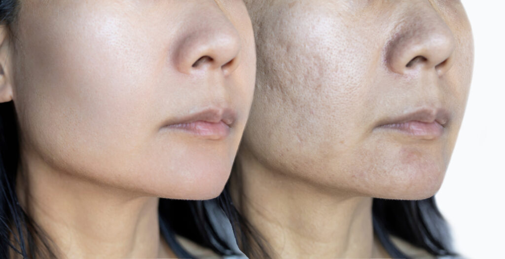 Collagen induction